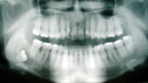 The wisdom teeth grow at the back of wisdom teeth usually grow through the gums during the late teens or early twenties. Impacted Wisdom Teeth What You Need To Know Westermeier Martin Dental Care