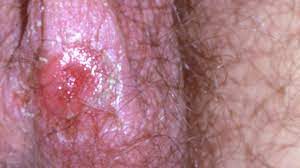 Herpes is one of the most common sexually transmitted diseases which can affect multiple organ systems including the lips and genitals. Is It Herpes Or Something Else Everyday Health