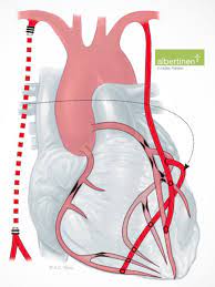 Noun the bridge is being rebuilt so we'll have to take the bypass. Bypass Operation Am Herzen Arterien Statt Venen Barmer