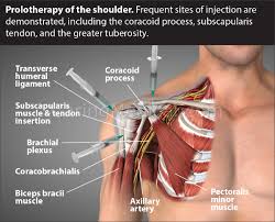 Repairing A Slap Tear Without Surgery Or Biceps Tenodesis Caring Medical Florida