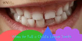 Read about how to floss your teeth properly and the best products to use to fight cavities. When To Pull A Child S Loose Tooth North Pointe Dental