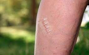 Zipstitch Una Tirita Que Permite Cerrar Heridas Abiertas Al Momento