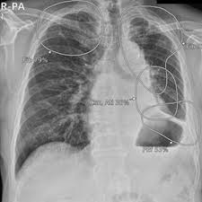 Image result for Chest XRay Interpretation