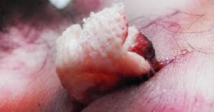 Résultat de recherche d'images pour "knife injuries"