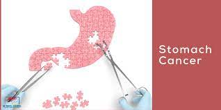Most cases of stomach cancers are gastric carcinomas. à¤ª à¤Ÿ à¤• à¤• à¤¸à¤° à¤²à¤• à¤·à¤£ à¤• à¤°à¤£ à¤šà¤°à¤£ à¤‰à¤ªà¤š à¤° à¤¶à¤² à¤¯à¤• à¤° à¤¯ à¤¡ à¤¨ à¤– à¤² à¤…à¤— à¤°à¤µ à¤²