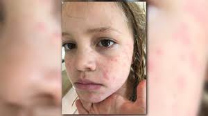 Common drugs that can cause hives on the face include antibiotics, especially sulfa drugs and penicillin, aspirin, and ace inhibitors used to control blood pressure. Meet Riley She S Allergic To The Cold Yes That S A Thing Wusa9 Com