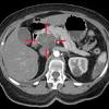 Although the great majority of both benign and malignant pancreatic neoplasms arise from pancreatic epithelial cells, mesenchymal tumors, while rare, can derive from the connective, lymphatic, vascular, and neuronal tissues of the pancreas 7. 1