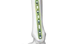 Metaphyseal Locking Plate System,Medical Device ...