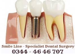 Arrogant Tooth Implant Oral Surgery Dentistlondon Wisdomteethswelling Teeth Implants Dental Implants Cost Dental Cosmetics