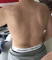 Diese pickelmale sind das resultat von falscher pickelbekämpfung. Was Hilft Pickel Am Rucken
