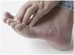 Peeling of the skin on the hands, mainly it can be because of very dry skin and they are exposed to multiple factors like soaps, detergents, sanitisers. What Causes Peeling Of The Skin On The Bottom Of A Foot Quora