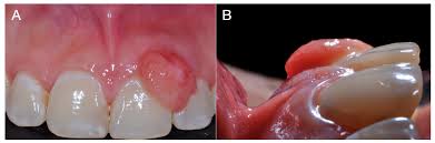 Image result for granuloma gum disease