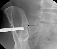 Check spelling or type a new query. Efficacy And Safety Of Bone Marrow Aspiration And Biopsy Using Fluoroscopic Guidance And A Drill Powered Needle Clinical Experience From 775 Cases Springerlink