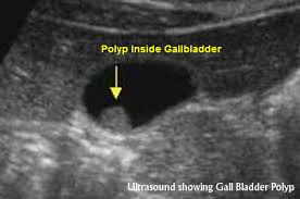 Get free & fast shipping on all orders over €100. Gallbladder Polyps Symptoms Diagnosis And Risks