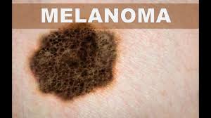 Resultado de imagen para cancer de melanomas
