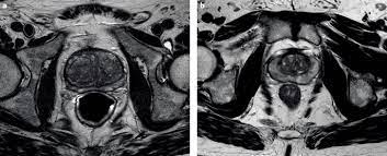 If you have a raised psa level, your doctor may refer you to hospital for an mri scan of your prostate. Multiparametric Mri For Prostate Cancer Diagnosis Current Status And Future Directions Nature Reviews Urology