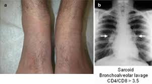 Image result for Panniculitis