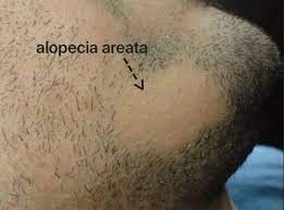 In alopecia, the autoimmune attacks are directed at hair follicles, where they become damaged. Scalp Alopecia In Men With Beard Alopecia What Are The Risks Donovan Hair Clinic
