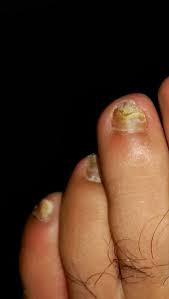 Los pacientes con mala vista o manos temblorosas deben pedir a otras personas que se las corten. Los Pies Y El Verano Micosis Ungueal Hongos En Las Unas