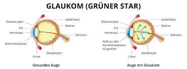 Der augeninnendruck, auch augenbinnendruck oder augendruck genannt, ist der druck, der im inneren des augapfels herrscht. Welche Anzeichen Sprechen Fur Einen Grunen Star