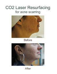 Pin On Laser Stretch Mark Removal