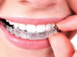 As invisalign® aligners put less force on your teeth than fixed braces, they're best suited to correcting mild or moderate bite problems. Will Invisalign Fix A Crossbite Or Overbite