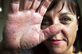 How is paraphenylenediamine allergy diagnosed? I M Allergic To Black Health Fitness Gulf News