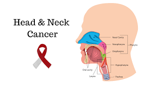 Cancer of the nasal cavity and paranasal sinuses. Head And Neck Cancer Awareness Month Nfcr