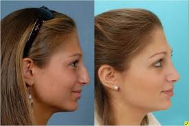 For some celebrities, a nose job is a treatment to enhance their looks. Rhinoplasty Johns Hopkins Facial Plastic And Reconstructive Surgery