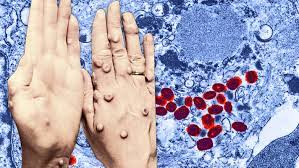 This Eradicated Disease Could Come Back As A Terrifying Biological Weapon