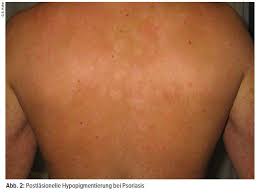 Maybe you would like to learn more about one of these? Klinisch Diagnostisches Vorgehen Bei Pigmentstorungen Dermatologie Universimed Medizin Im Fokus