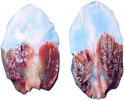 Why is it that only the pineal gland calcifies? Pine Detox Club