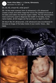 3D/4D Ultrasounds in MN