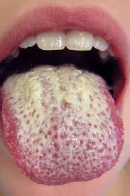 White Spots on My Tongue - Indigestion | Causes | Diagnosis | Treatment | Best | Homeopathic | Gastroenterologist | in | Pakistan | Homeopathic | Best Homeopathic Doctor in Pakistan | Dr Qaisar Ahmed MD, DHMS
