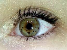 Tigroid Iris With A Number Of Dark Brown Nevi Eye Art Eye Color Facts Crazy Eyes