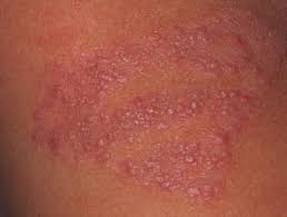 Black henna is extremely dangerous to health since it is a transdermal toxin and a potential carcinogen apart from the fact that it causes allergy in many of those who use black henna. Black Henna Tattoo Reaction Dermnet Nz
