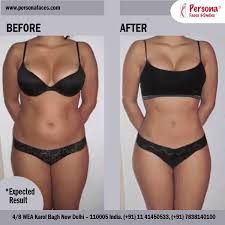 Body Contouring Is It For You Not Everyone Who Loses A Lot Of Weight Needs Body Contouring Surgery Moreover D Skin Tightening Procedures Liposuction Laser Lipo