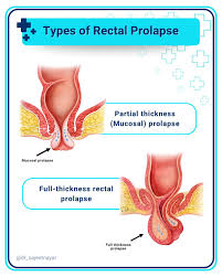 Image result for Rectal Prolapse