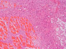 Image result for Polymyositis