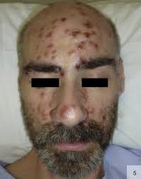 Image result for Secondary Syphilis