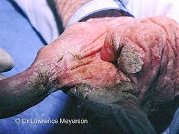 Image result for scabies norvegica