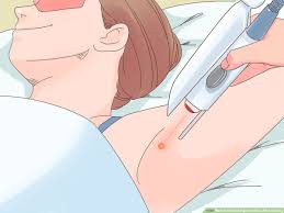 This often happens after shaving, when hairs grow back into the skin instead of out toward the light — creating a nasty red bump. 3 Ways To Prevent Ingrown Hairs After Shaving Wikihow