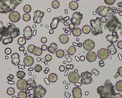 Mean urine ph adjusted for confounding factors is. Types Of Crystals In Urine