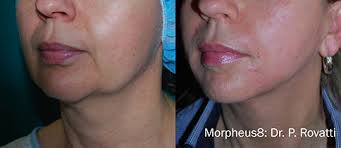 We did not find results for: Embracerf Morpheus8 Full Body Fractional Technology Visage Dermatology