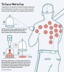 mets latch on to cupping therapy and have the marks to