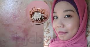 Hanya Guna Campuran Asam Jawa Bedak Sejuk Parut Jerawat Wanita Ini Hilang Dalam Masa Seminggu Wow Hijabista