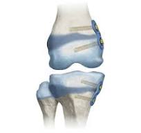 Epiphhyseal Plate - Auxein: Pioneering Orthopedic Solutions ...