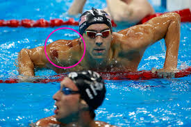 Michael fred phelps ii is known principally as the most decorated olympian of all time, with a total of 28 olympic medals, 23 of them gold, spanning over four olympic games. Spots On Michael Phelps What Is Cupping