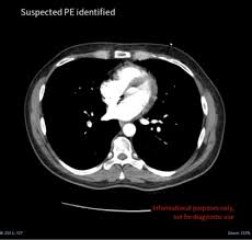 Image result for Incidental Imaging Finding