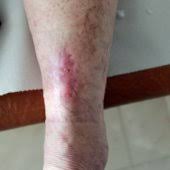 We did not find results for: Martorell Ulcer